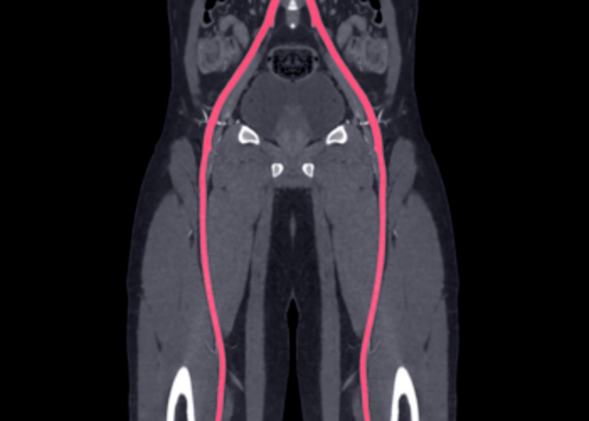 Peripheral Interventions