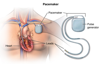 Coronary Angioplasty