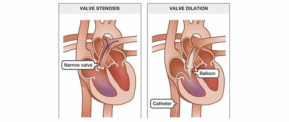 Balloon Valvuloplasty
