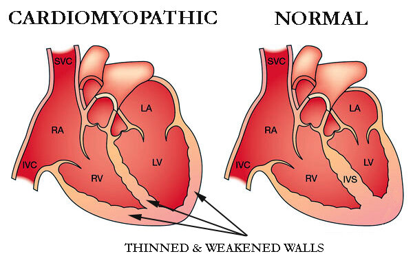 Cardiomyopathy treatment in Pune