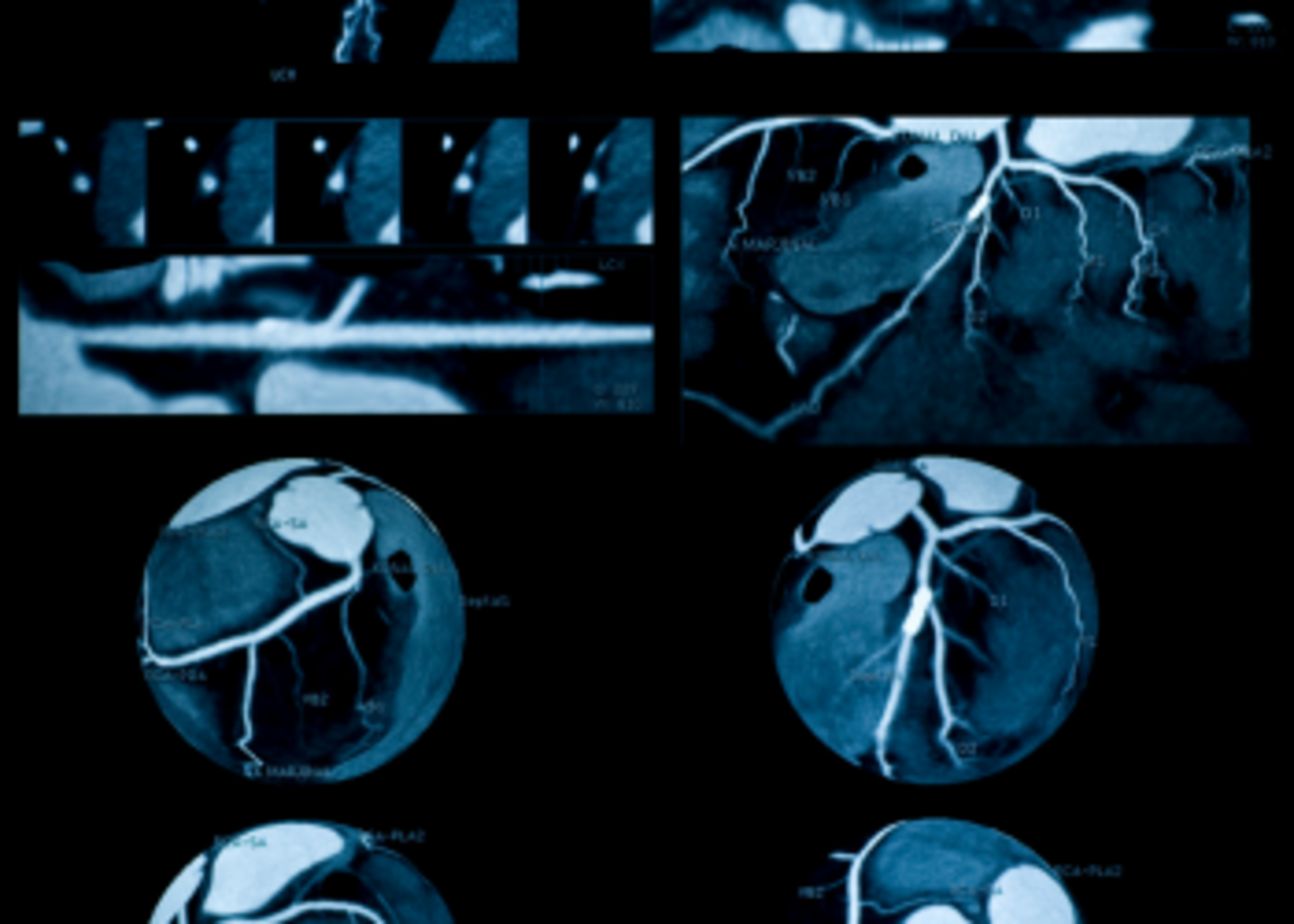 Coronary Angiography